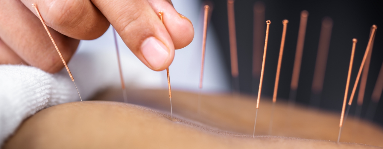 Acupuncture-Comfort-2-Cure-Nepean-ON