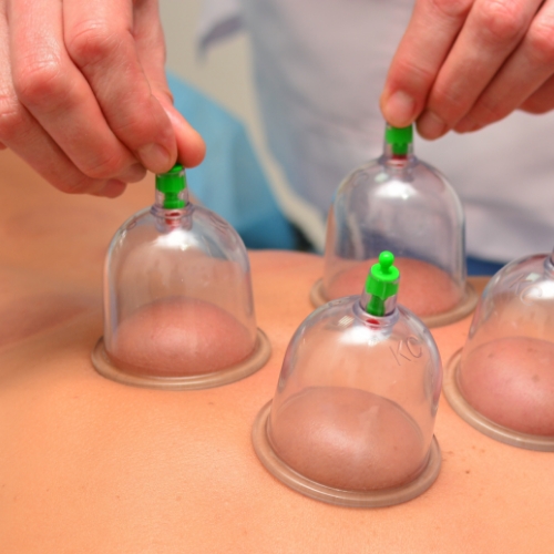 Cupping-Comfort-2-Cure-Nepean-ON